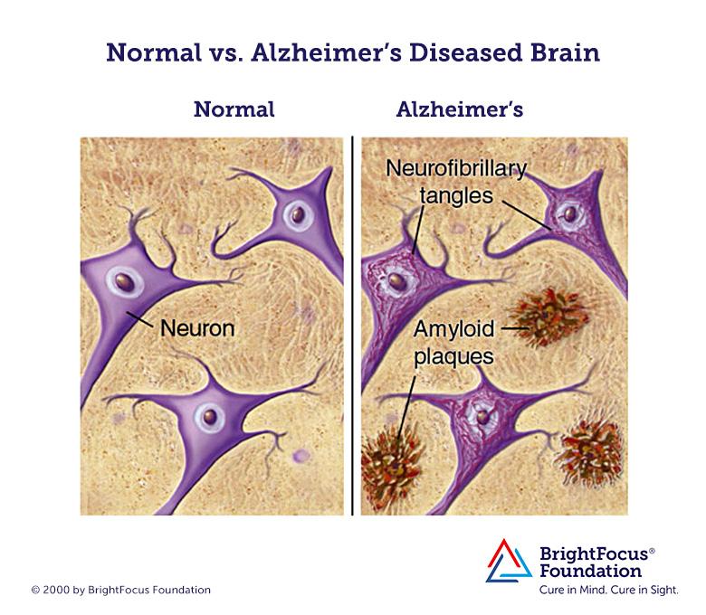 Normal_vs_Alzheimers_Brain